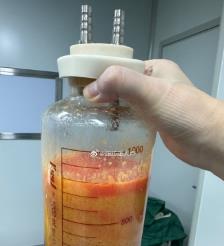 淇县水动力吸脂手术要做多久？